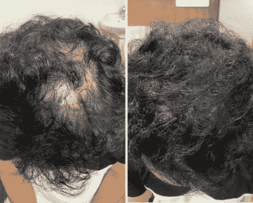 Hair Loss Treatment Before After