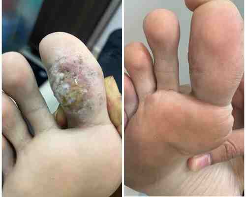 Skin Infection Treatment Before After