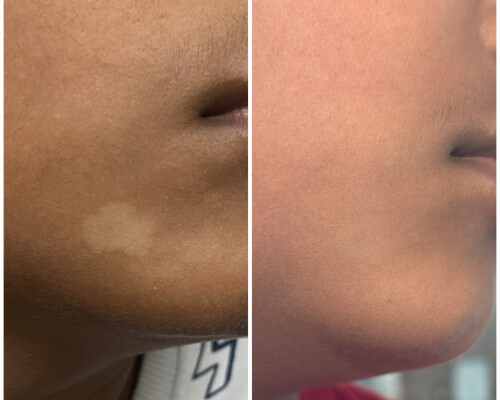 Skin Pigmentation Before After