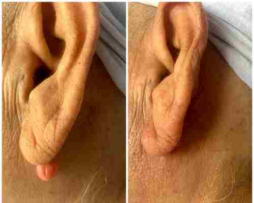 Keloid Treatment Before After
